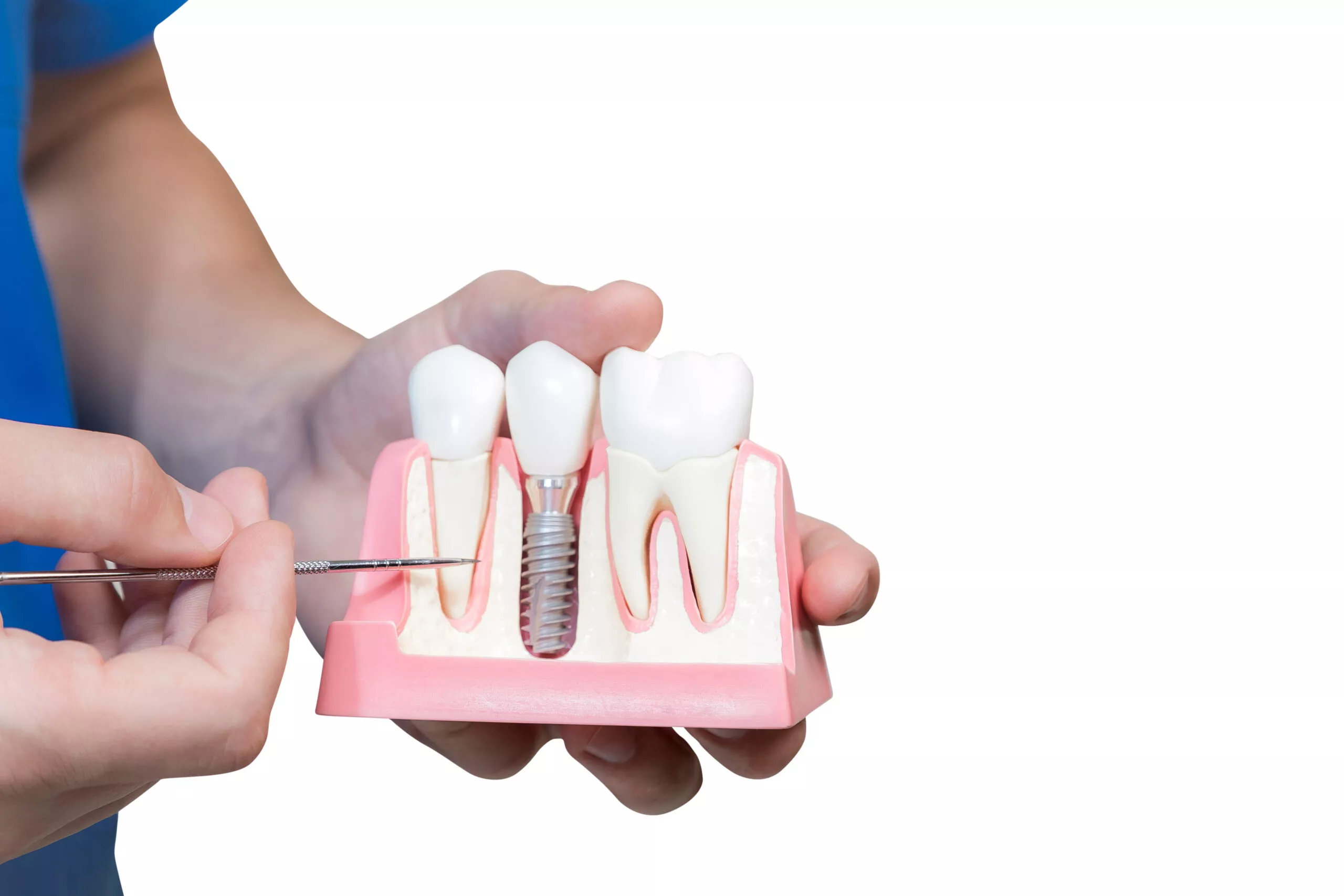  Dental Implant