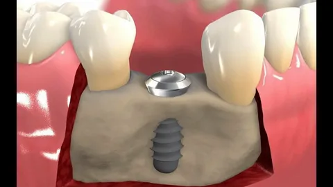 Dental Implants Alexandria